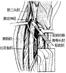 腓骨取骨术图片