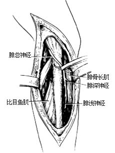 吻合血管的腓骨切取术图片