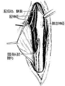 吻合血管的腓骨切取术图片