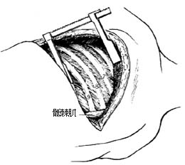 吻合血管的肋骨切取术图片
