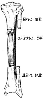 受区骨（肌、皮）移植术图片