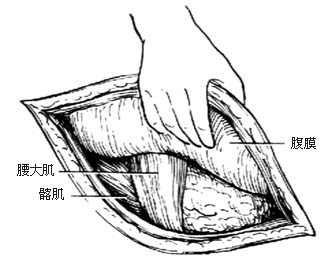 肾移植术图片