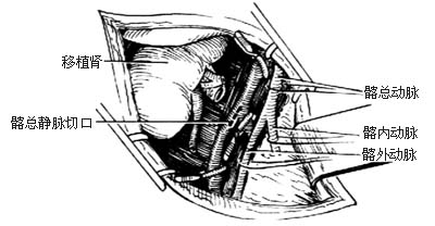 肾移植术图片