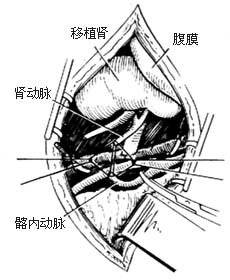 肾移植术图片