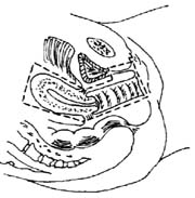 前盆脏器切除术图片