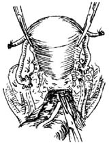 前盆脏器切除术图片