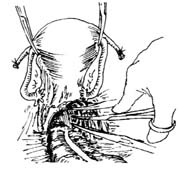 前盆脏器切除术图片
