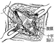 前盆脏器切除术图片