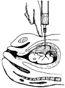 中期妊娠引产术图片