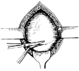 子宫下段剖宫产术图片