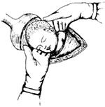 子宫下段剖宫产术图片