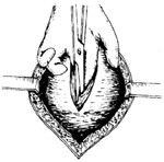 古典式剖宫产术图片