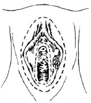 单纯外阴切除术图片