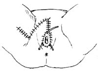 广泛外阴切除术图片