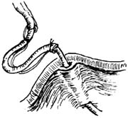 输尿管阴道瘘修补术图片