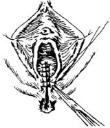 直肠阴道瘘修补术图片