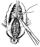 直肠阴道瘘修补术图片
