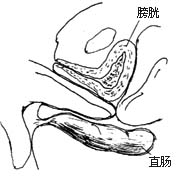 阴道成形术图片