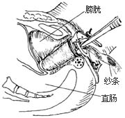 阴道成形术图片