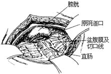 阴道成形术图片