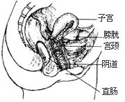 阴道前、后壁膨出（脱垂）修复术图片