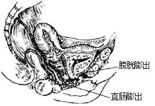 阴道前、后壁膨出（脱垂）修复术图片