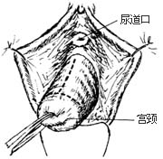 阴道前、后壁膨出（脱垂）修复术图片