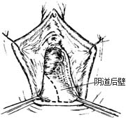 阴道前、后壁膨出（脱垂）修复术图片