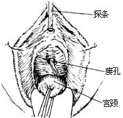 膀胱阴道瘘修补术图片