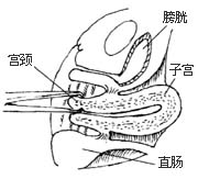 阴式全宫切除术图片