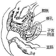 膀胱阴道瘘修补术图片