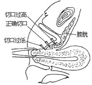 阴式全宫切除术图片