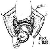 阴式全宫切除术图片