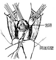 阴式全宫切除术图片