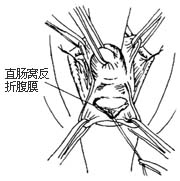 阴式全宫切除术图片