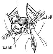 阴式全宫切除术图片