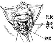 阴式全宫切除术图片