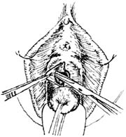 膀胱阴道瘘修补术图片
