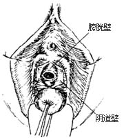 膀胱阴道瘘修补术图片