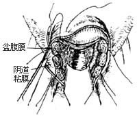 阴式全宫切除术图片