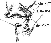 膀胱阴道瘘修补术图片