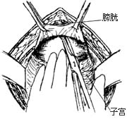 膀胱阴道瘘修补术图片