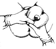臂位阴道助产术图片