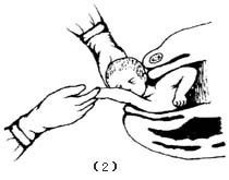肩难产助产术图片