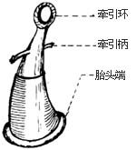 胎头吸引术图片