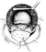 囊袋内人工晶体植入术图片