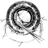 囊袋内人工晶体植入术图片
