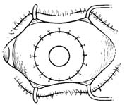全板层角膜移植术图片