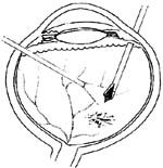 外伤眼的玻璃体手术图片