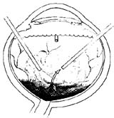 糖尿病性视网膜病变的玻璃体手术图片